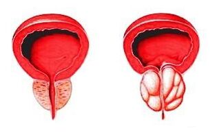 Próstata en estado normal (esquerda) e inflamada con prostatite (dereita)