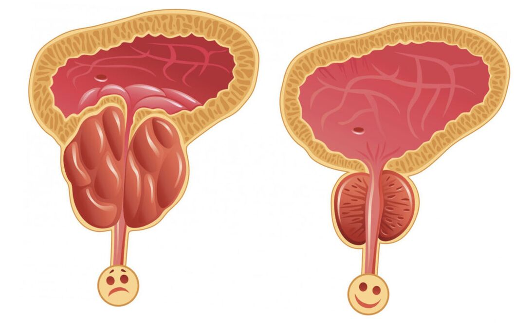 A inflamación da próstata con prostatite (esquerda) e a próstata é normal (dereita)