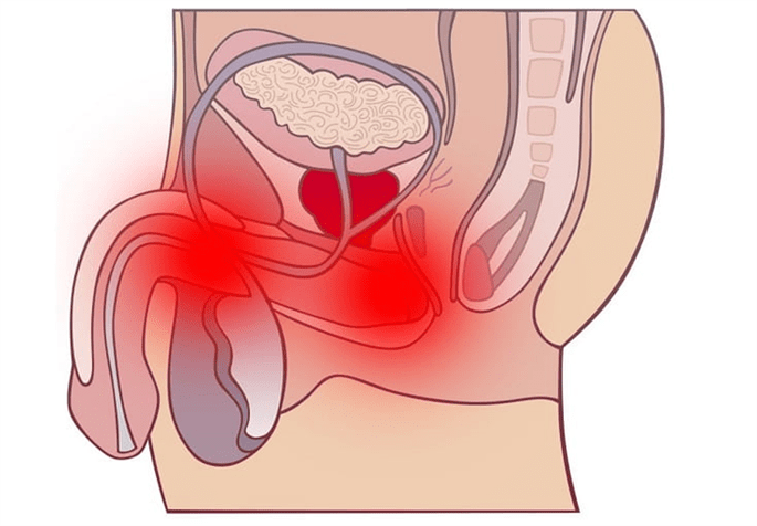 Inflamación do tracto xenital con prostatite
